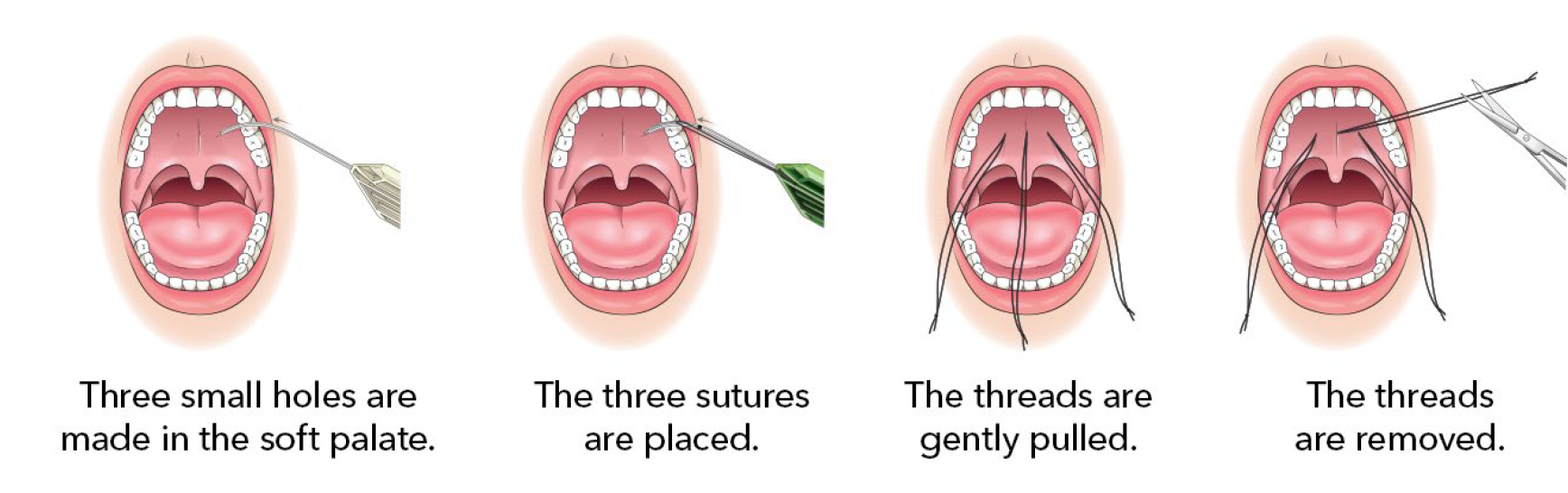 elevoplasty procedure steps